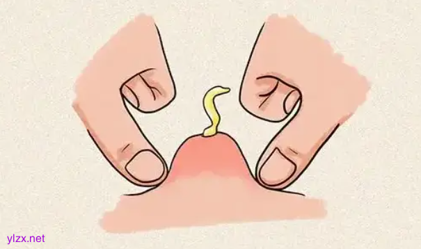 这种“红包”又痛又肿 硬挤真的很危险
