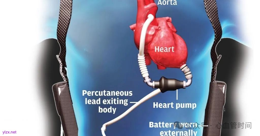 HeartMate II